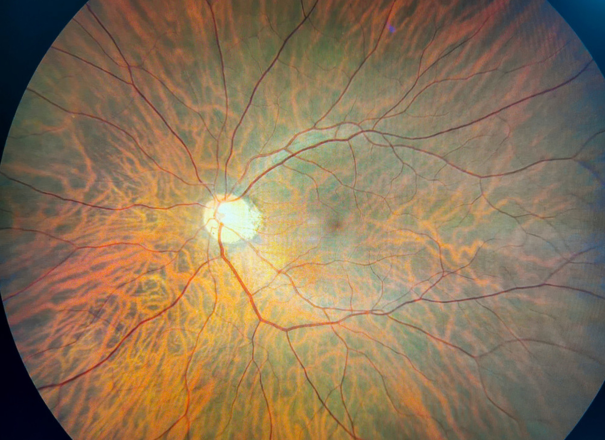 Retina